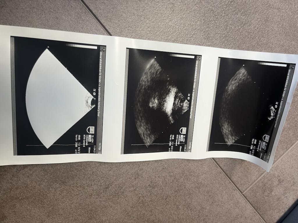 Acuson Schlucksonde TE-V5M  38382 gebraucht